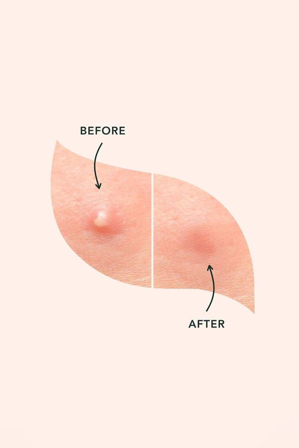 Some By Mi Clear Spot Patch